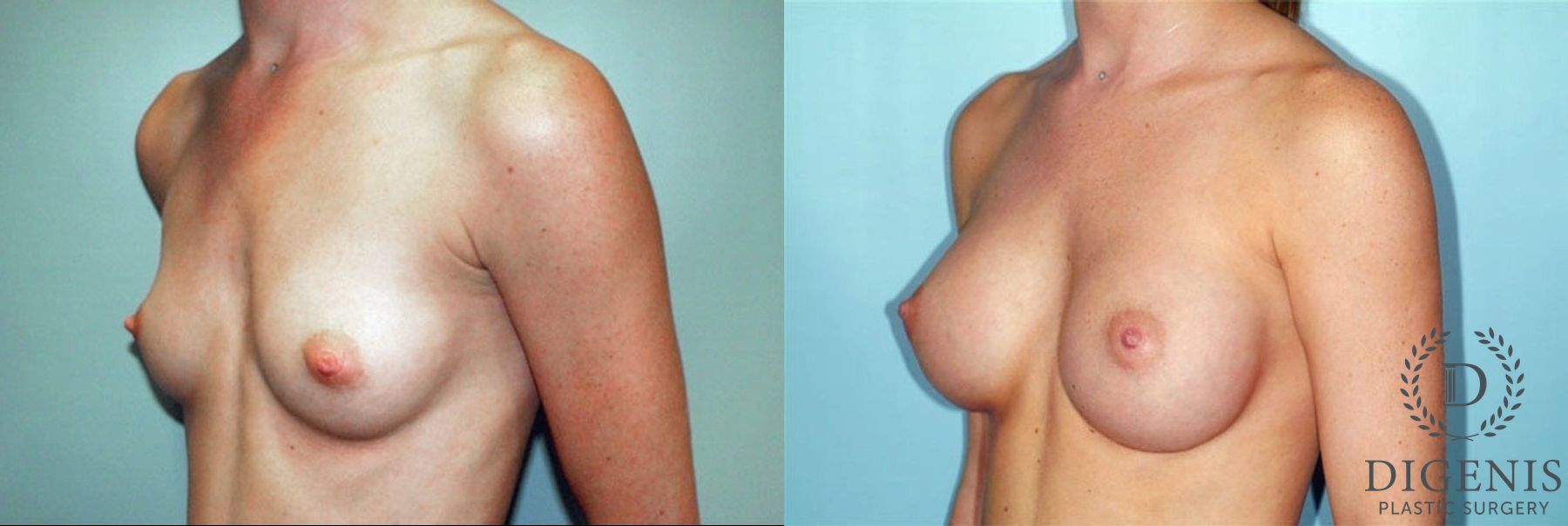 Before and after Breast Augmentation case 35038