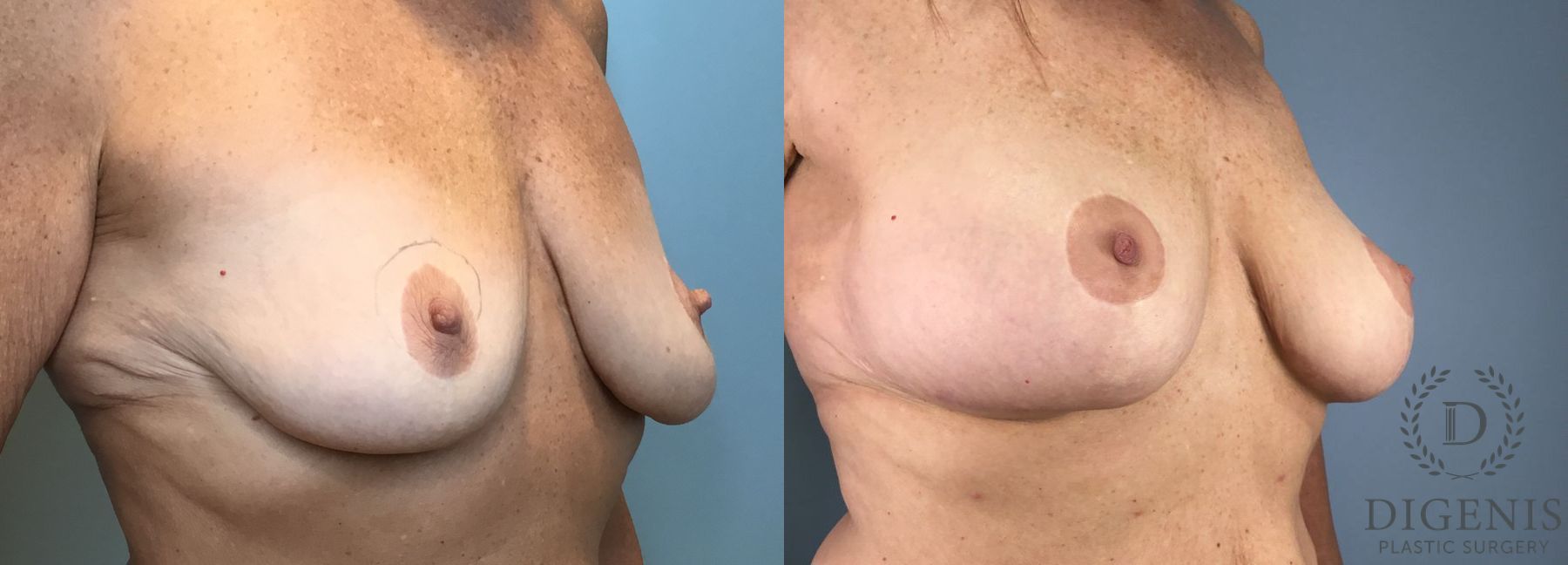 Before and after Breast Augmentation case 43362 - Angle 2