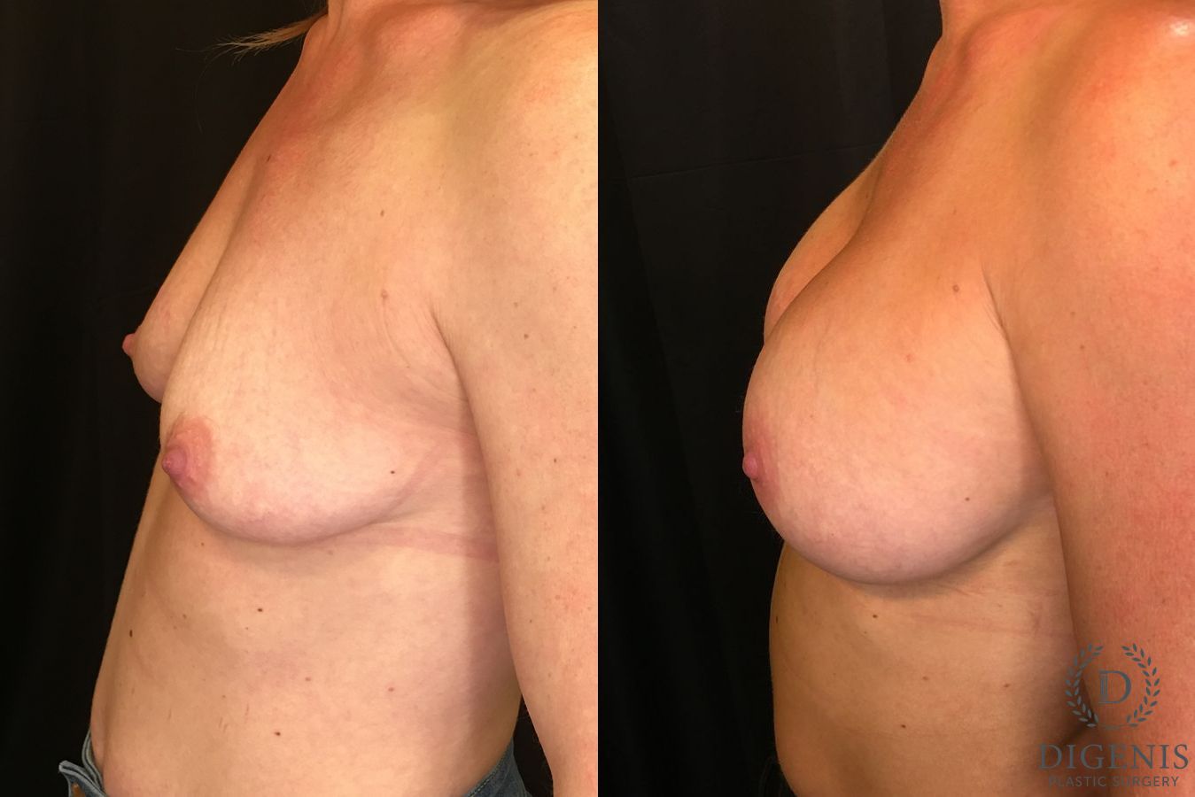 Before and after Breast Augmentation case 35136 - Angle 5