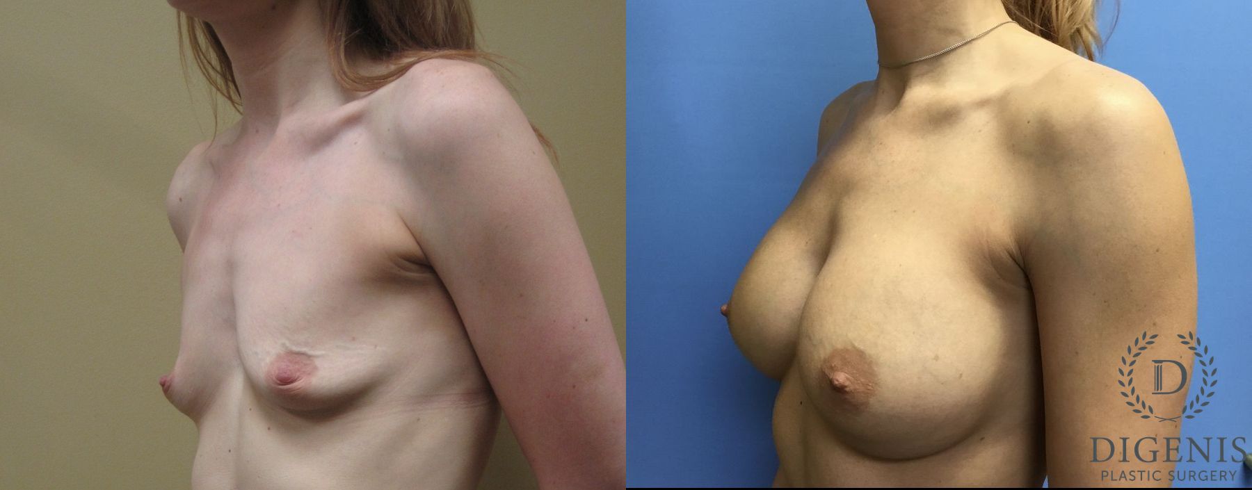 Before and after Breast Augmentation case 35041 - Angle 4