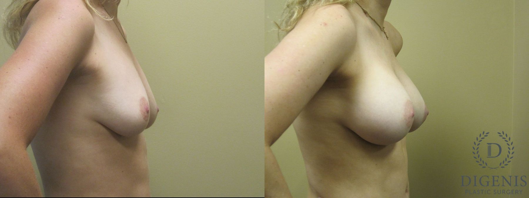 Before and after Breast Augmentation case 35106 - Angle 3