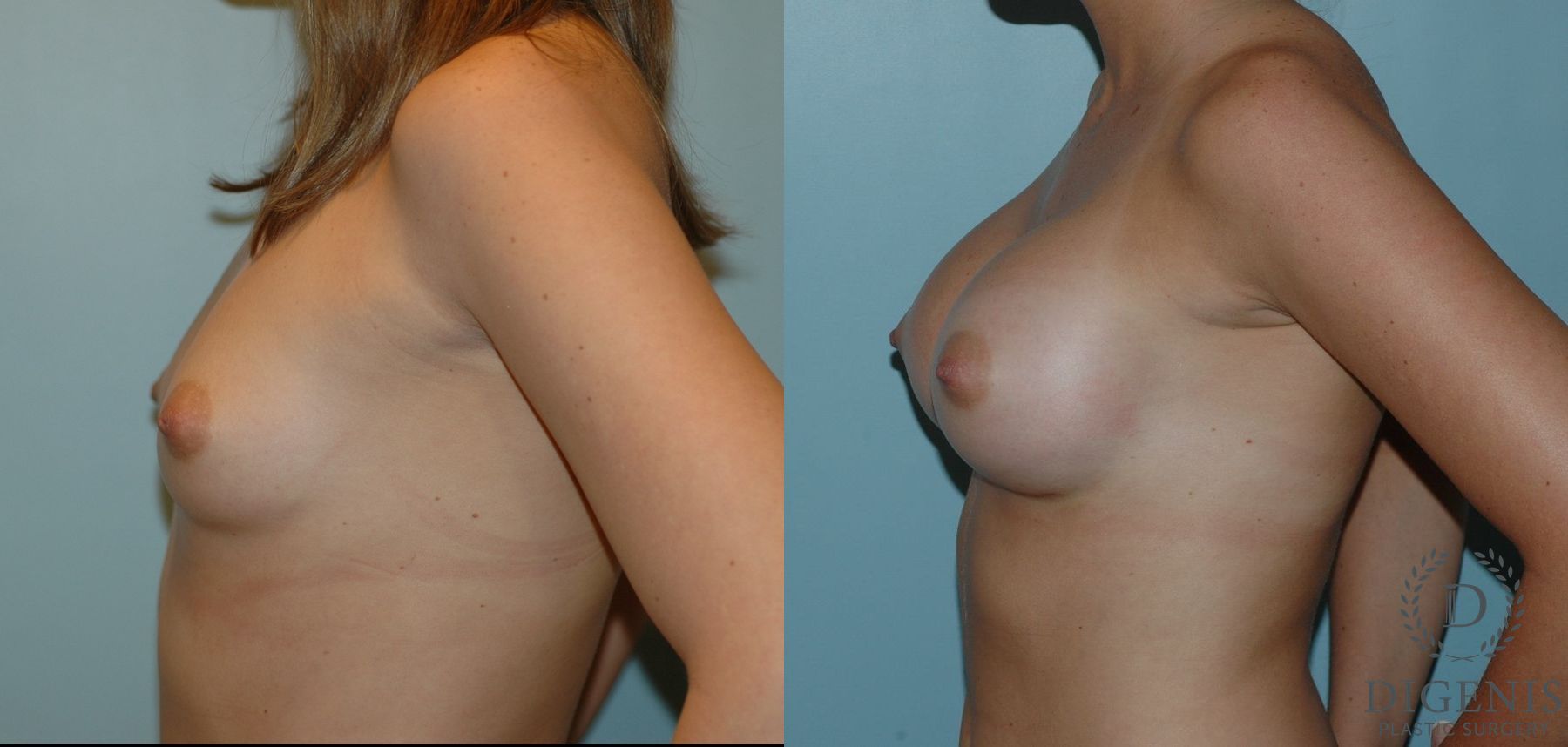 Before and after Breast Augmentation case 35084 - Angle 3