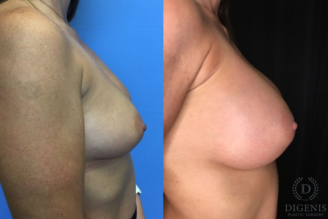 Before and after Breast Augmentation case 35176 - Angle 3