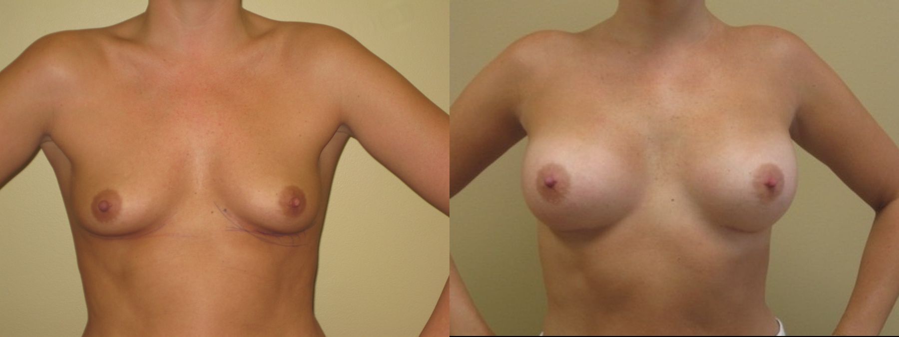 Before and after Breast Augmentation case 35081