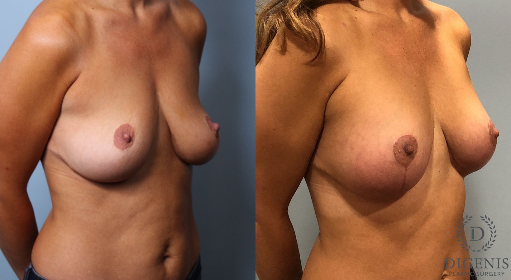 Before and after Breast Augmentation case 35116 - Angle 2