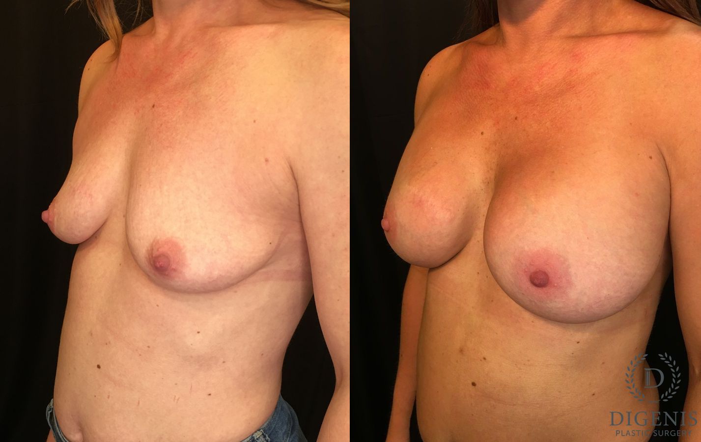 Before and after Breast Augmentation case 35136 - Angle 4