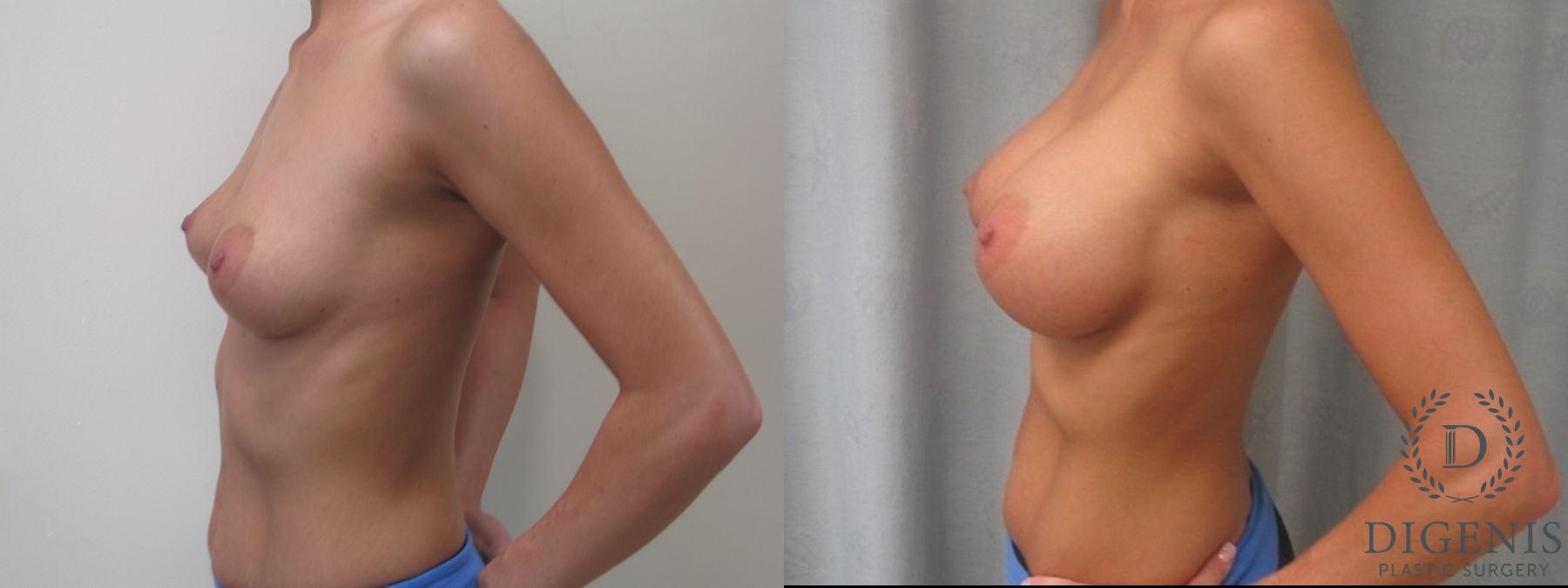 Before and after Breast Augmentation case 35087 - Angle 3