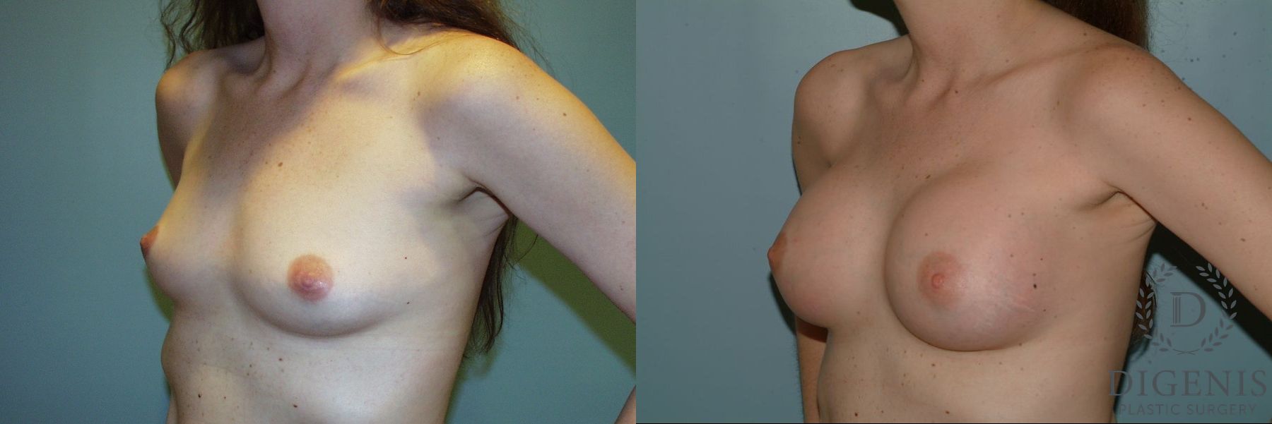 Before and after Breast Augmentation case 35080 - Angle 2