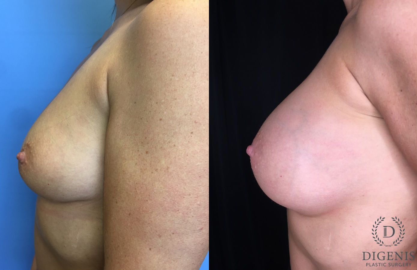 Before and after Breast Augmentation case 35176 - Angle 5