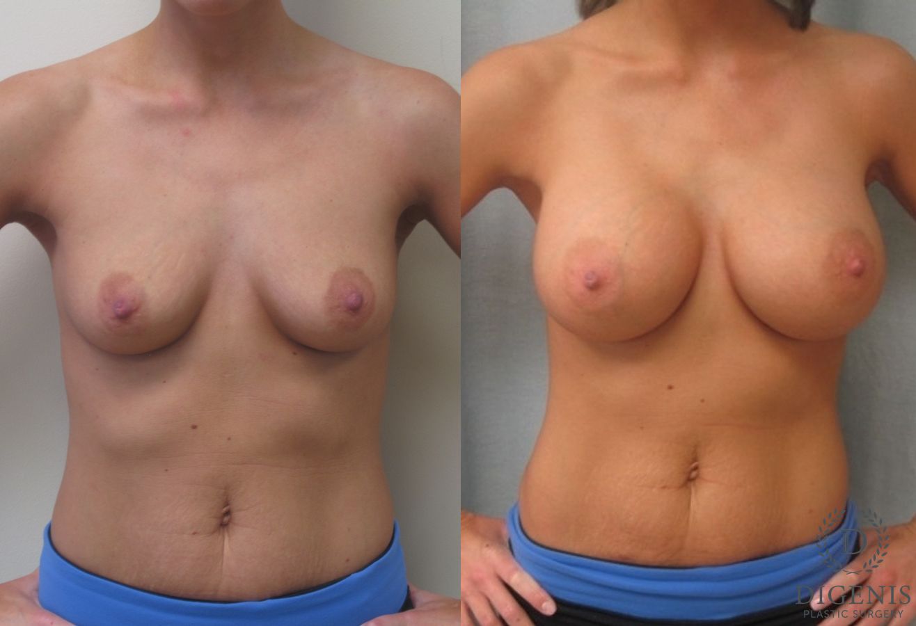 Before and after Breast Augmentation case 35087