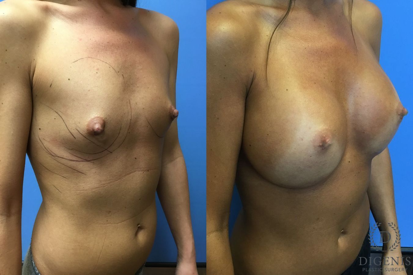 Before and after Breast Augmentation case 35110 - Angle 2