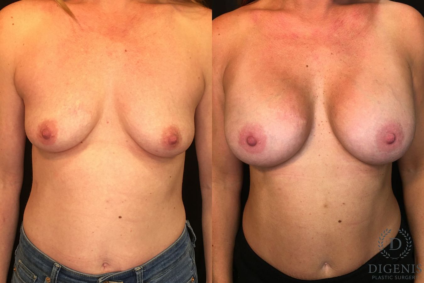 Before and after Breast Augmentation case 35136