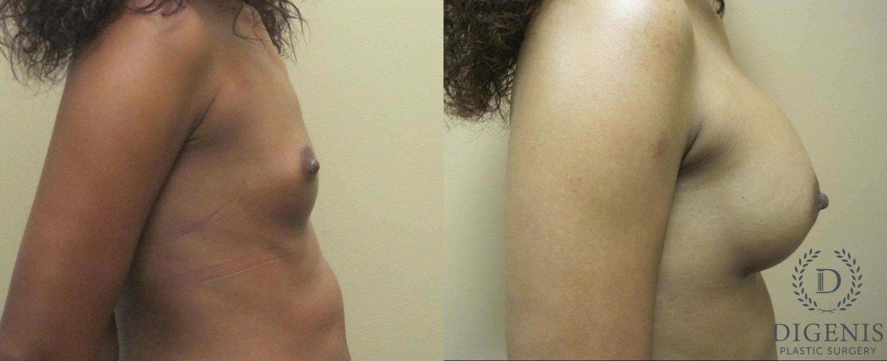 Before and after Breast Augmentation case 35123 - Angle 2