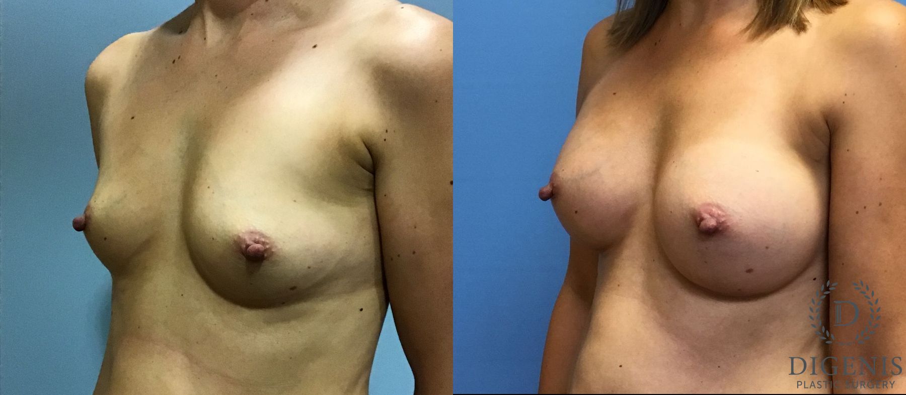 Before and after Breast Augmentation case 35113 - Angle 4