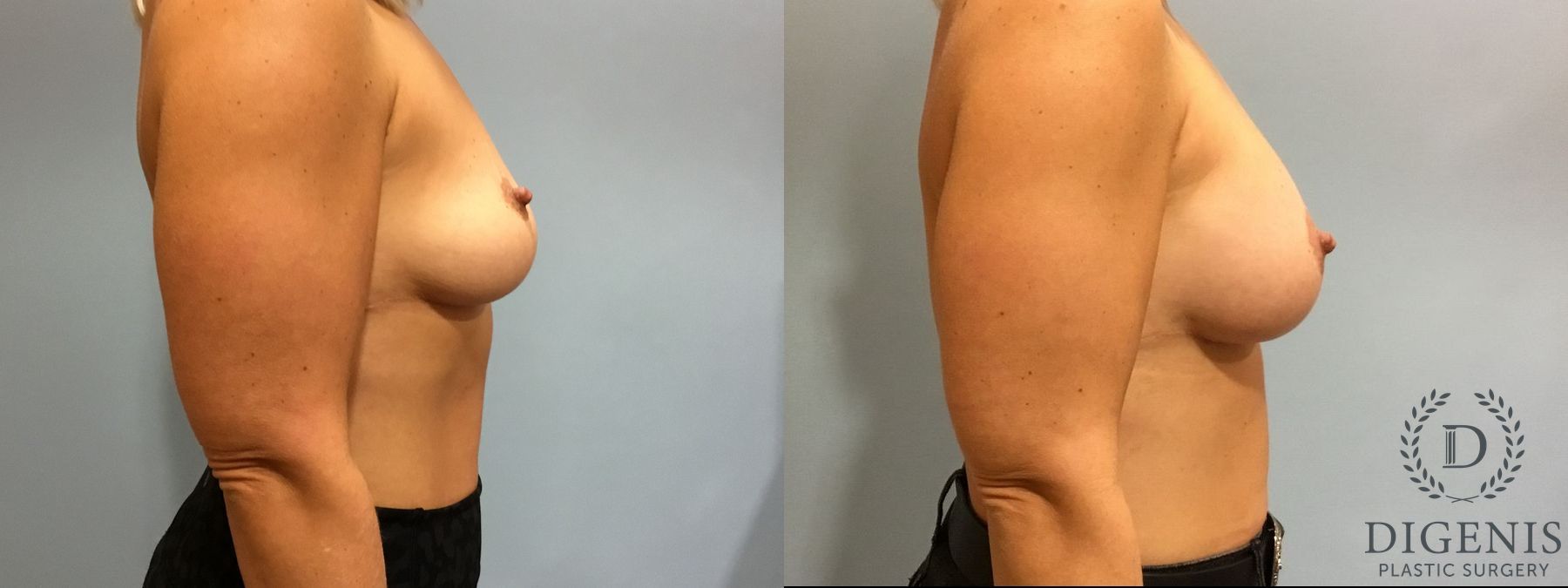 Before and after Breast Augmentation case 35114 - Angle 3