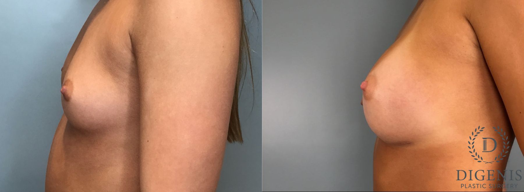 Before and after Breast Augmentation case 43431 - Angle 5