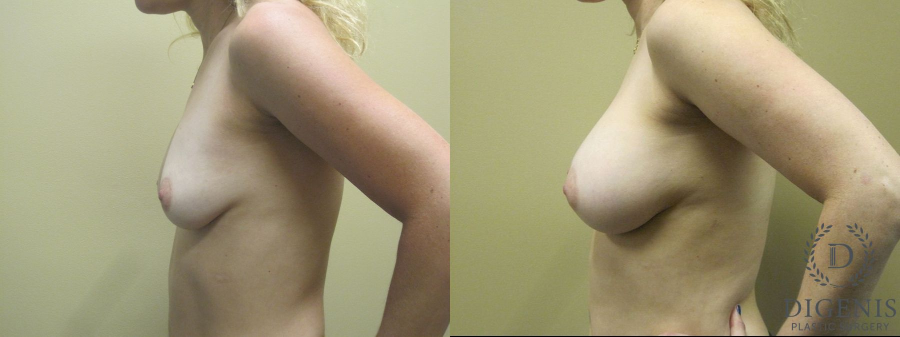 Before and after Breast Augmentation case 35106 - Angle 5