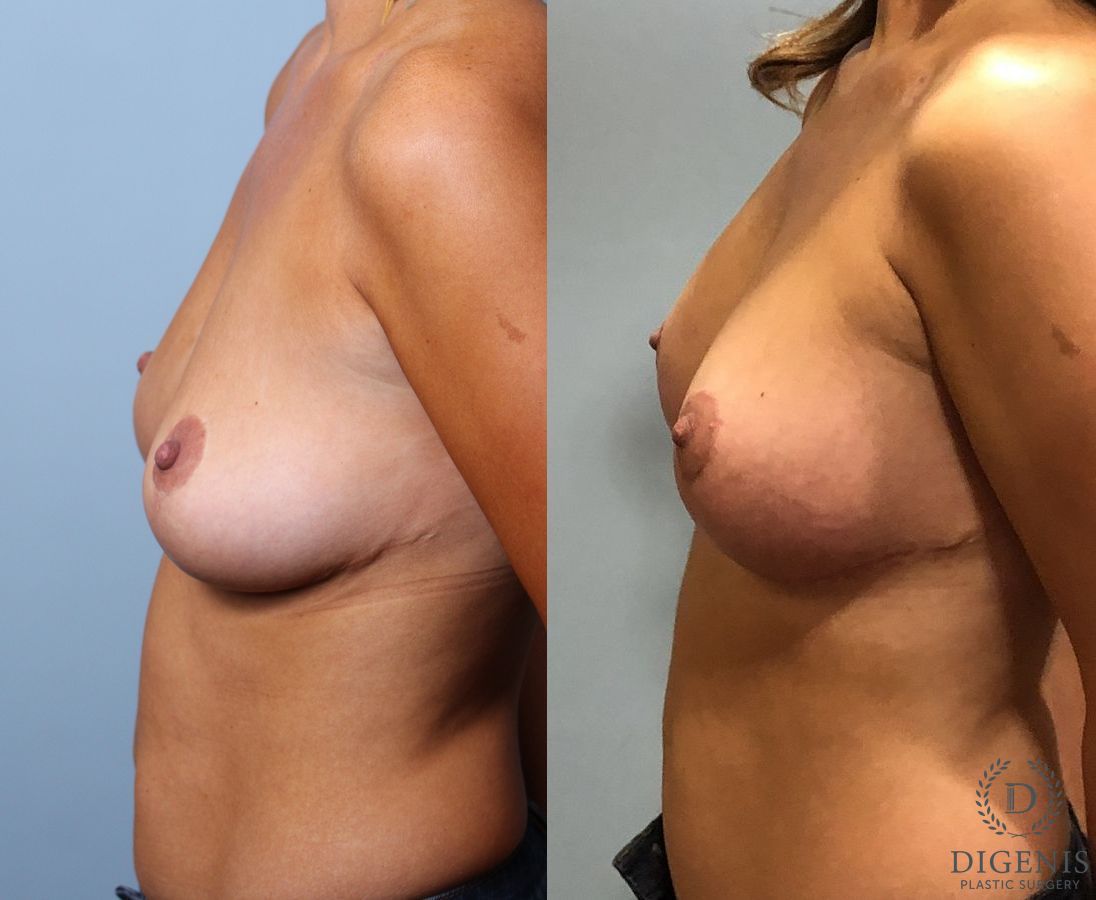 Before and after Breast Augmentation case 35116 - Angle 5