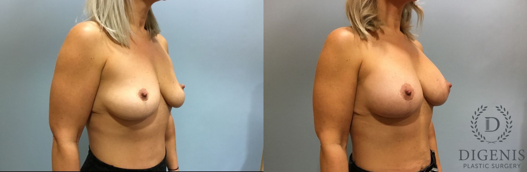 Before and after Breast Augmentation case 35114 - Angle 2