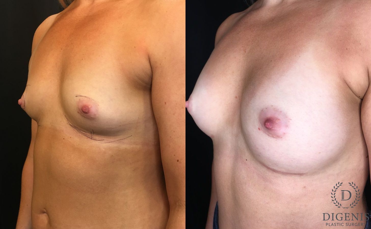 Before and after Breast Augmentation case 35166 - Angle 4