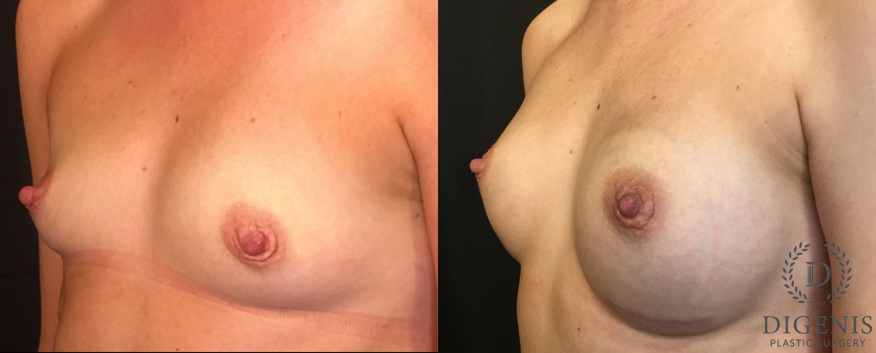 Before and after Breast Augmentation case 35050 - Angle 4