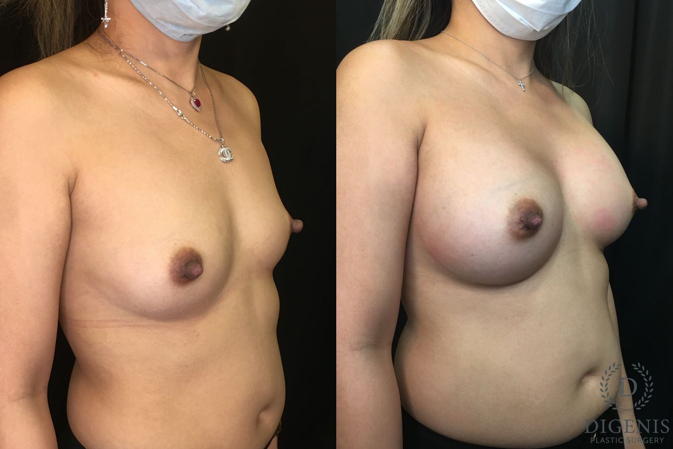 Before and after Breast Augmentation case 35165 - Angle 2