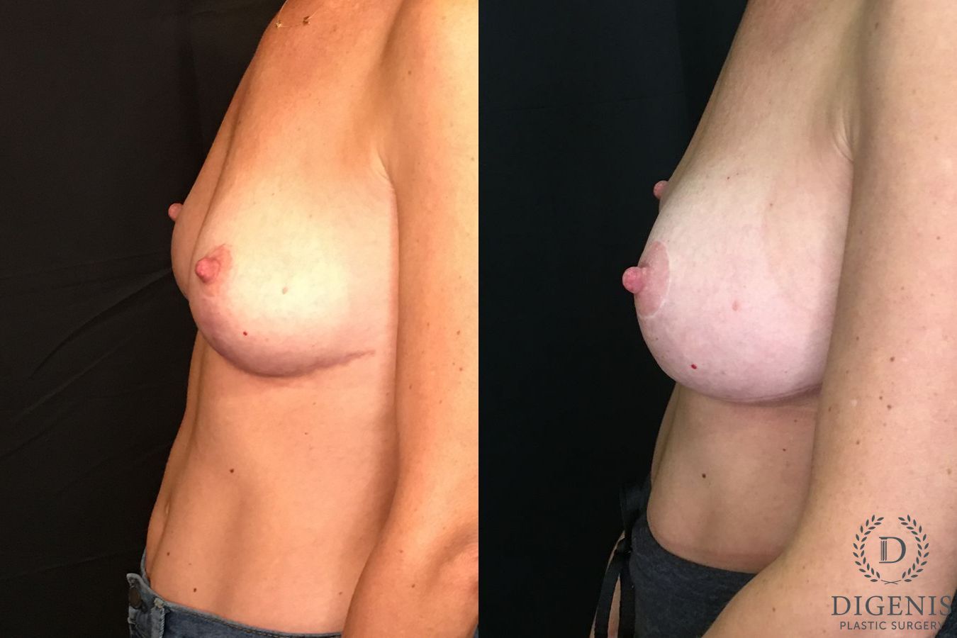 Before and after Breast Augmentation case 35187 - Angle 5