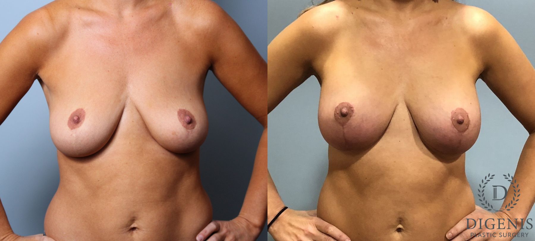 Before and after Breast Augmentation case 35116