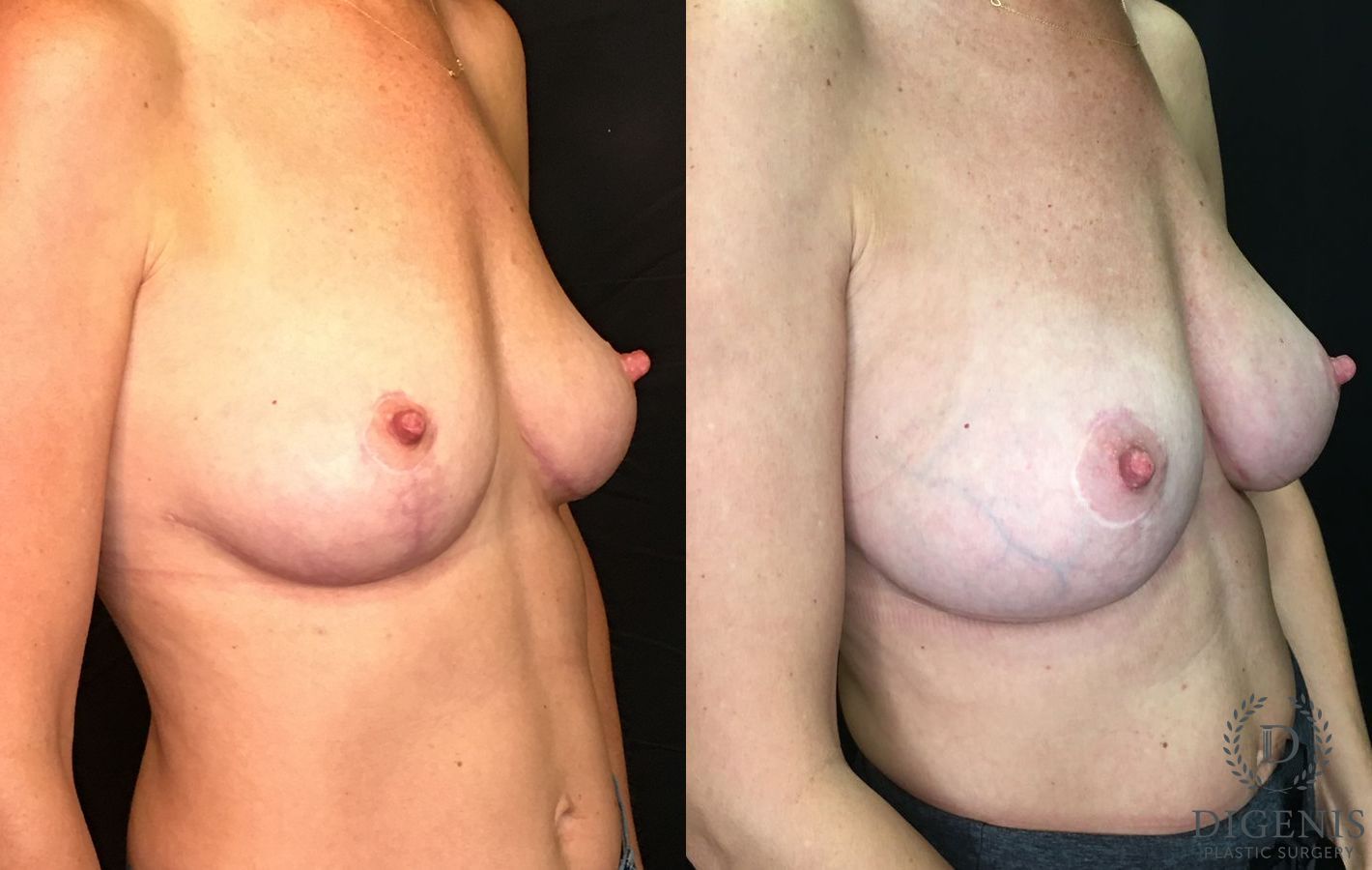 Before and after Breast Augmentation case 35187 - Angle 2