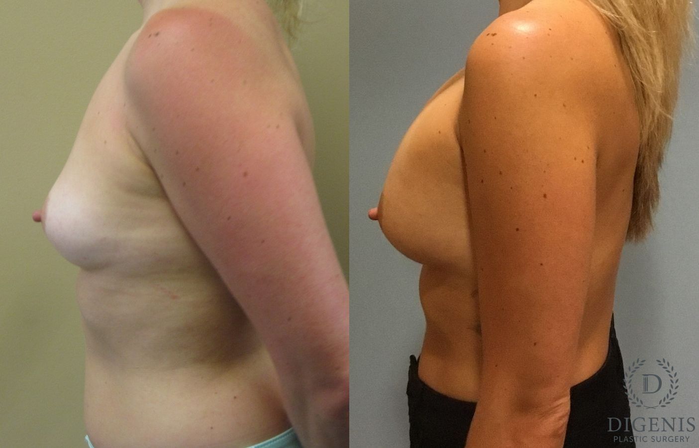 Before and after Breast Augmentation case 35091 - Angle 5