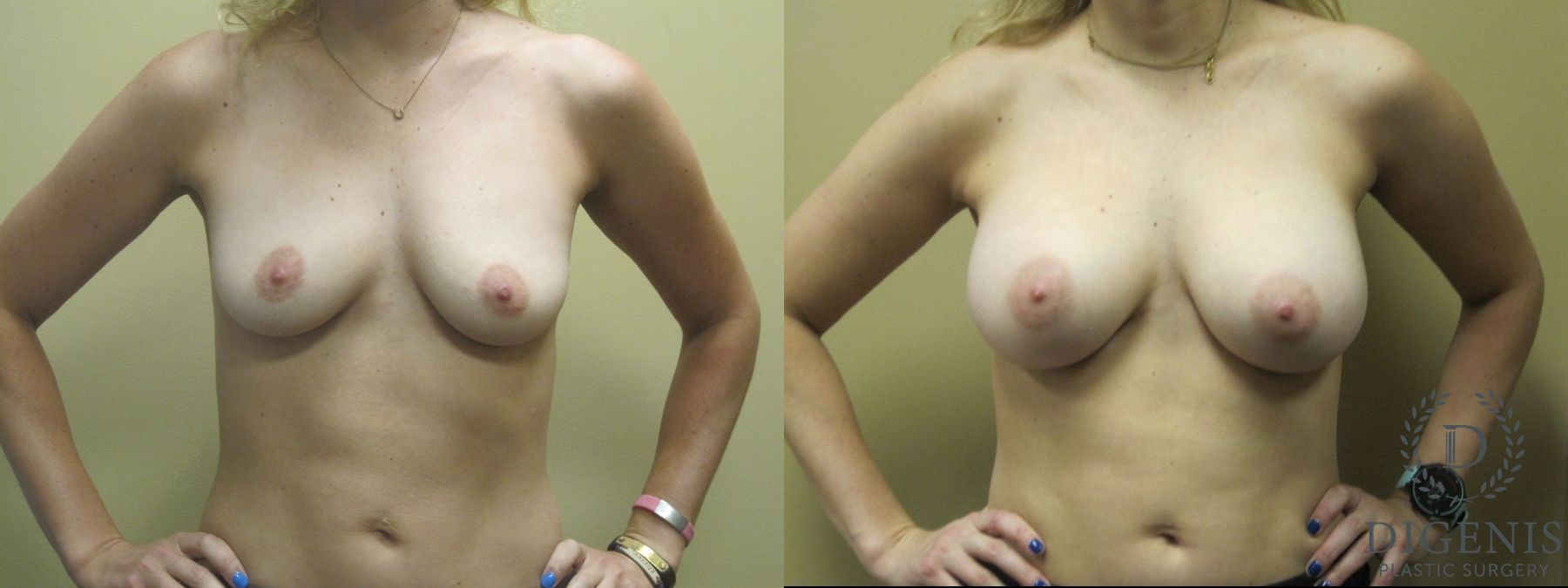 Before and after Breast Augmentation case 35106