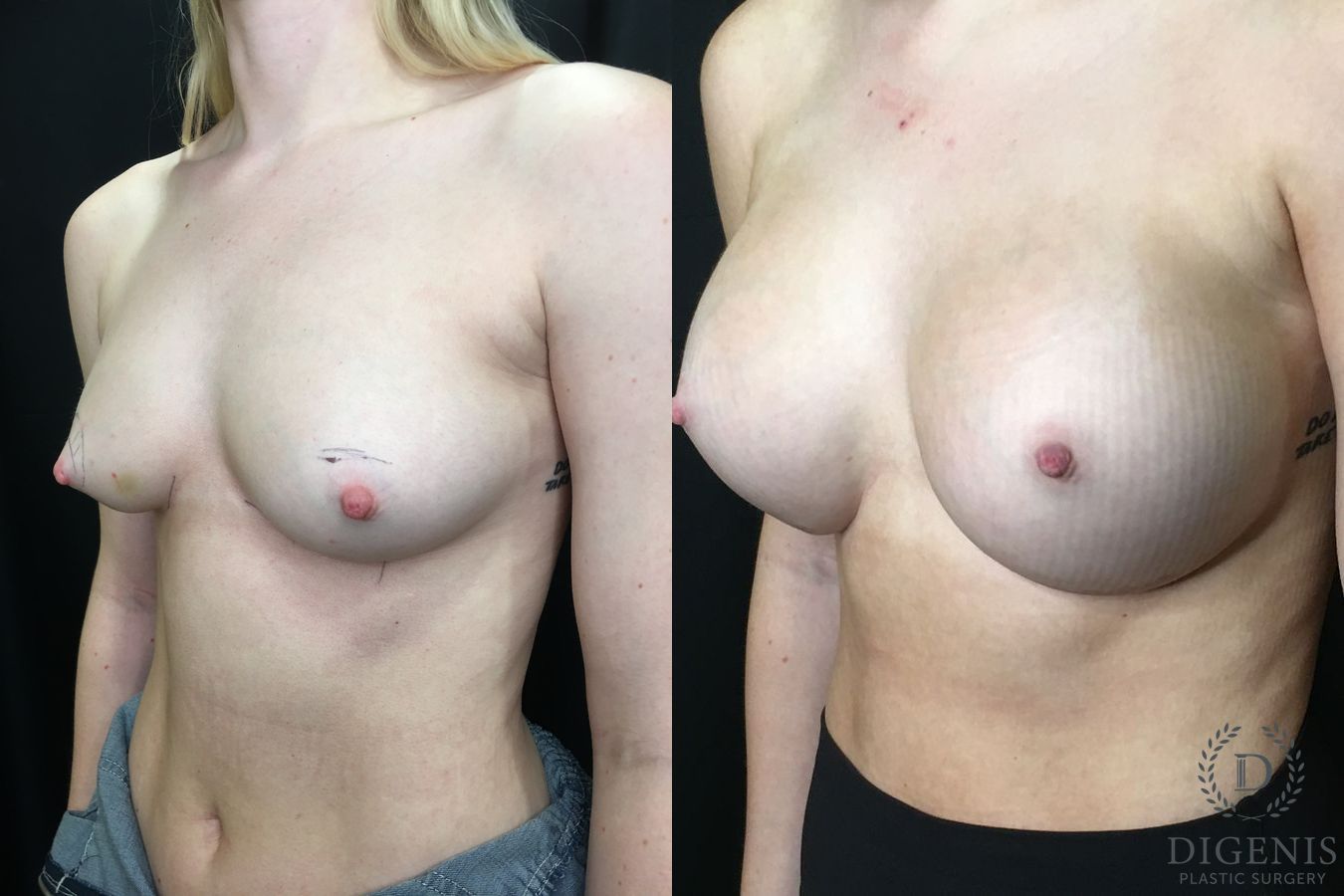Before and after Breast Augmentation case 35177 - Angle 4