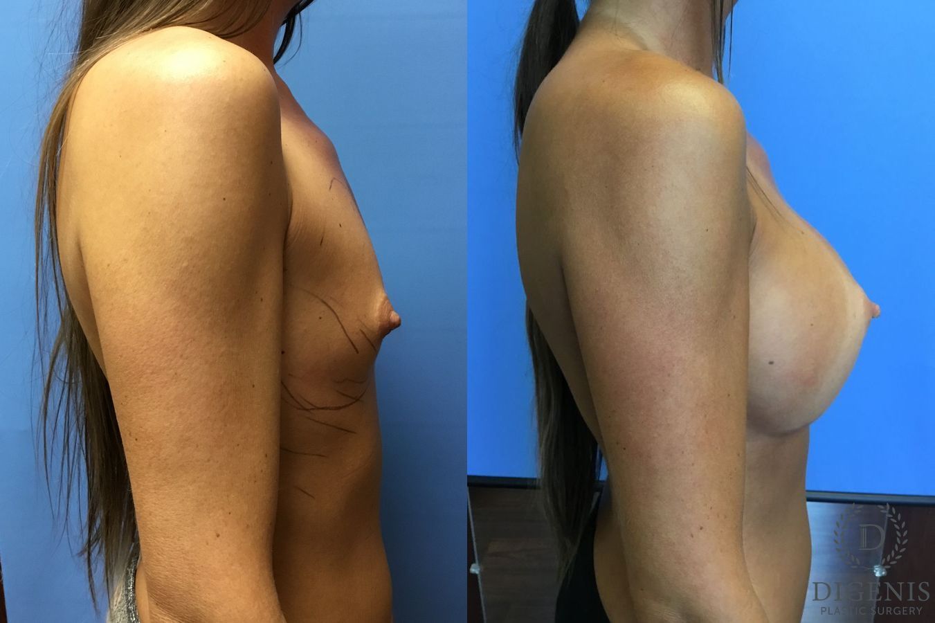 Before and after Breast Augmentation case 35110 - Angle 3