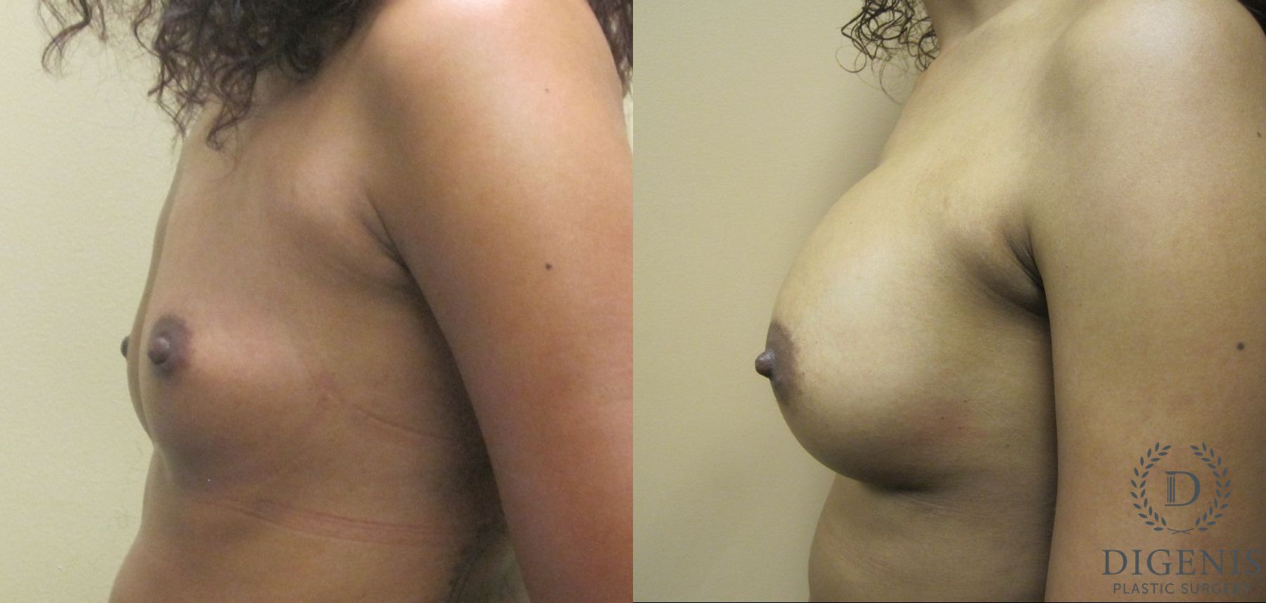 Before and after Breast Augmentation case 35123 - Angle 3