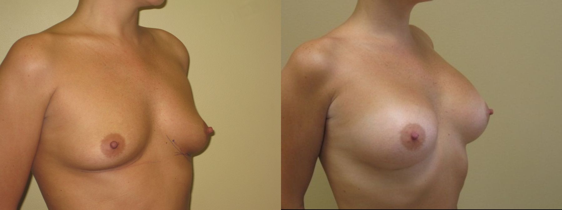 Before and after Breast Augmentation case 35081 - Angle 2