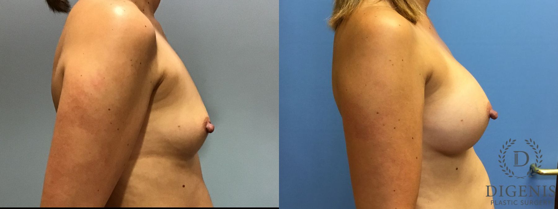 Before and after Breast Augmentation case 35113 - Angle 3