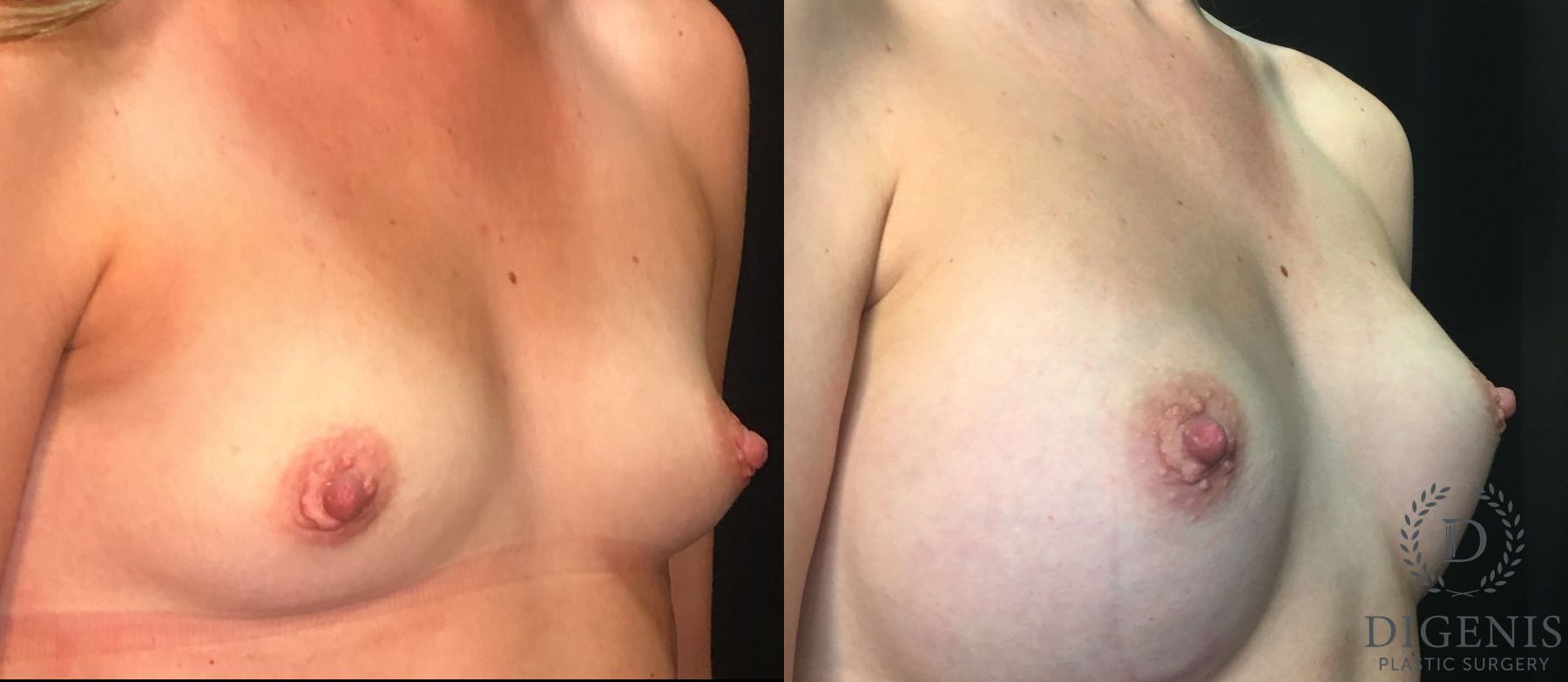 Before and after Breast Augmentation case 35050 - Angle 2