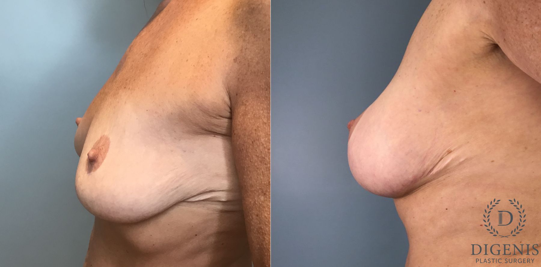 Before and after Breast Augmentation case 43362 - Angle 5