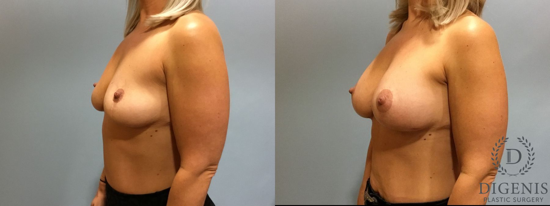 Before and after Breast Augmentation case 35114 - Angle 4