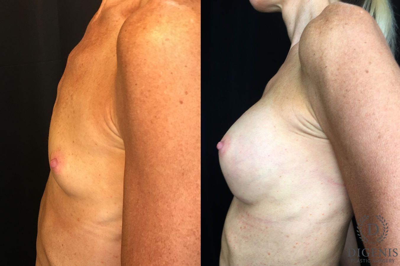 Before and after Breast Augmentation case 35172 - Angle 5
