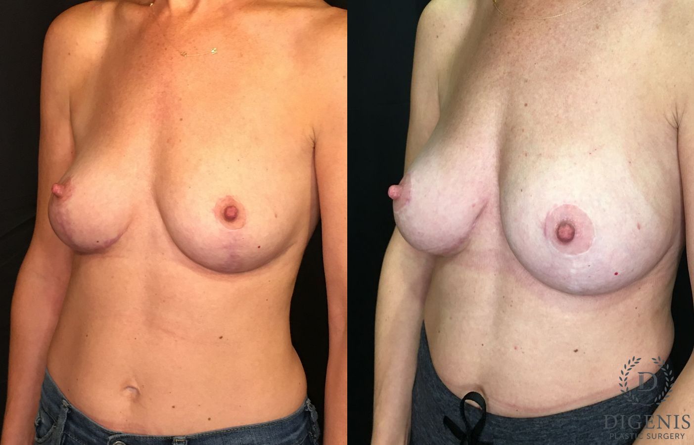 Before and after Breast Augmentation case 35187 - Angle 4