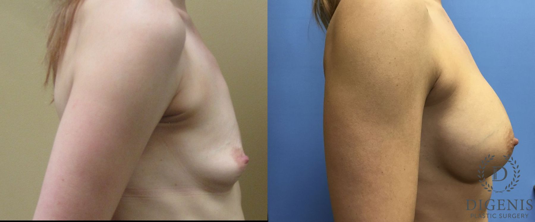Before and after Breast Augmentation case 35041 - Angle 3