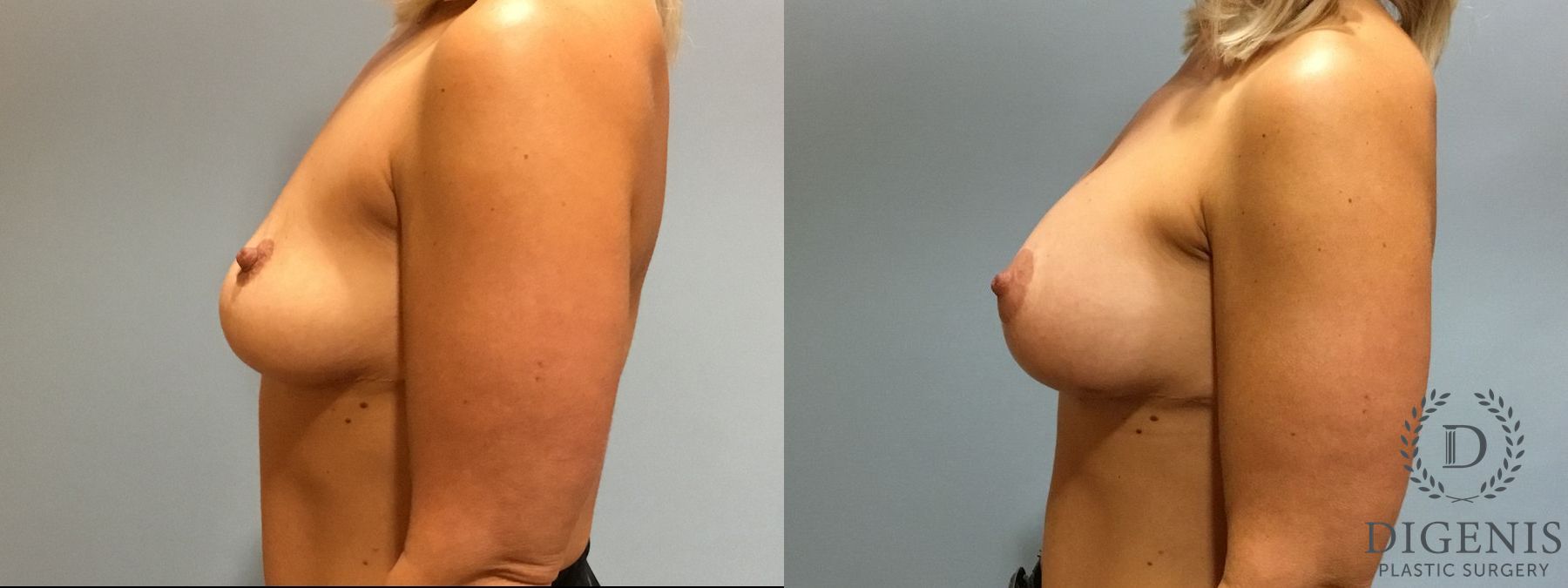 Before and after Breast Augmentation case 35114 - Angle 5