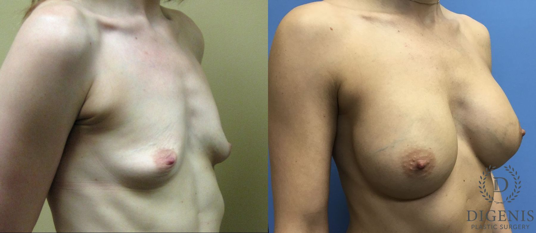 Before and after Breast Augmentation case 35041 - Angle 2
