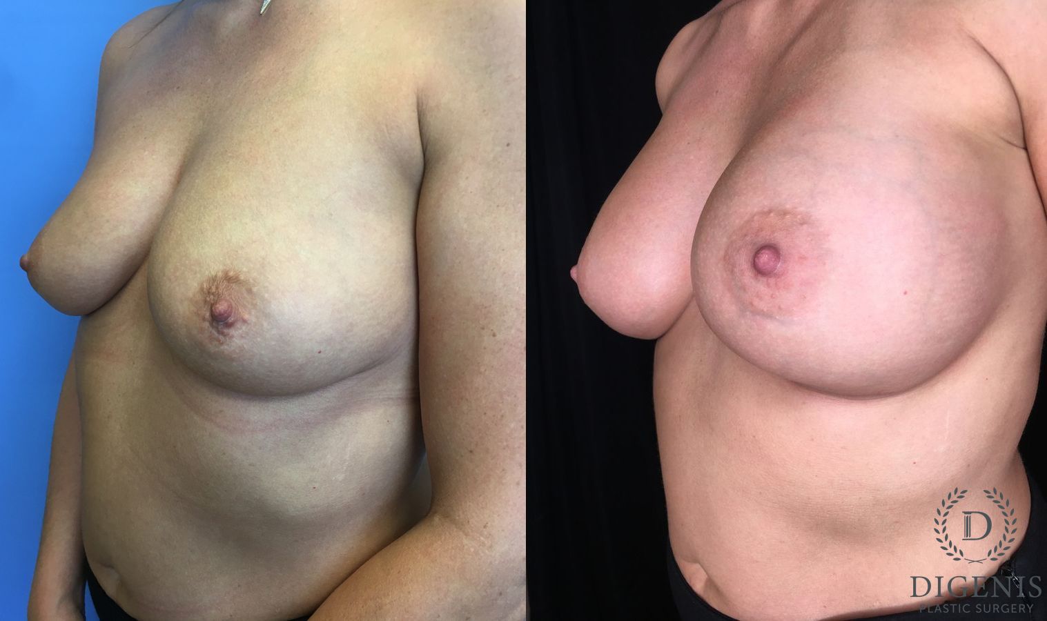 Before and after Breast Augmentation case 35176 - Angle 4