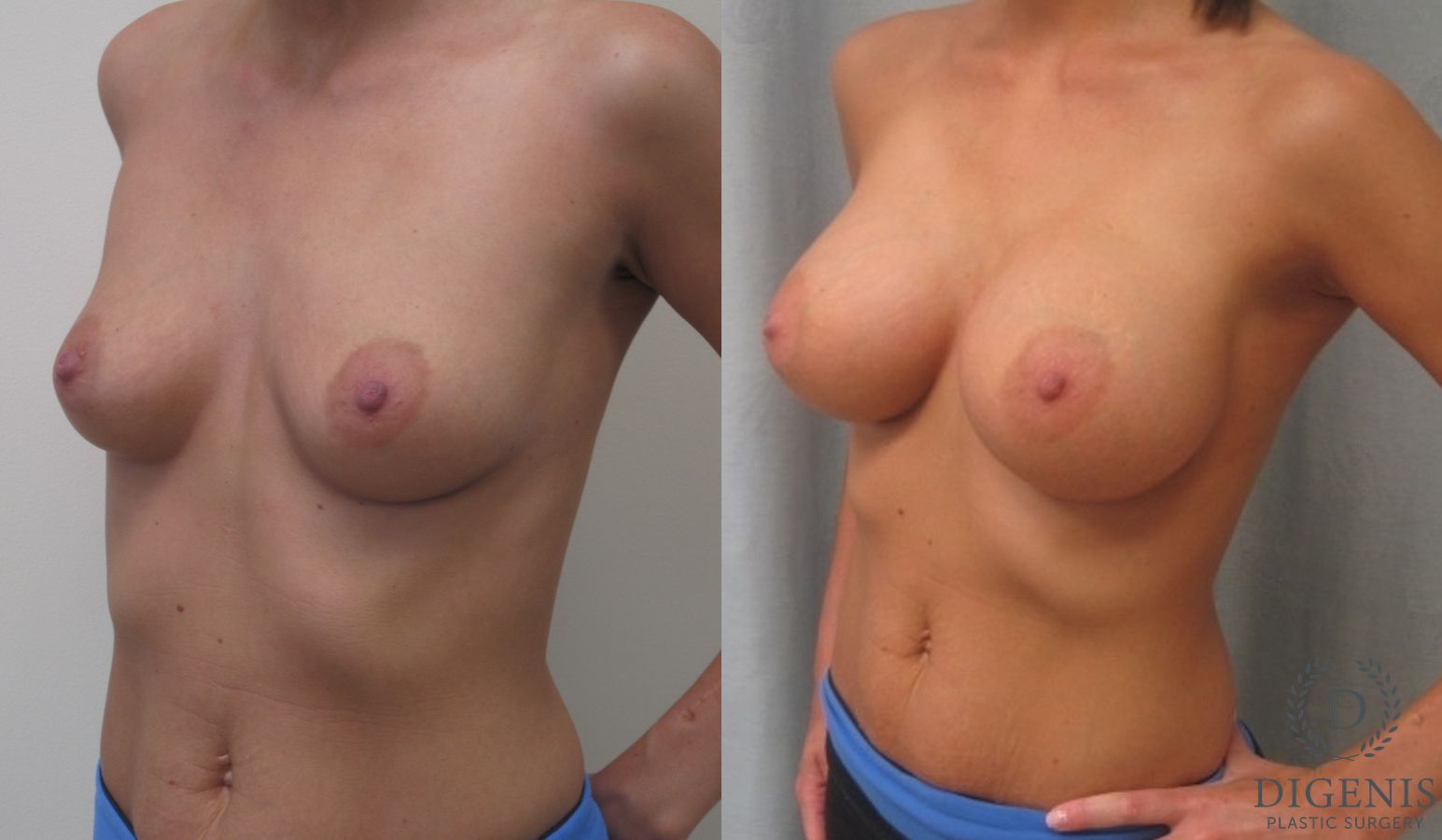 Before and after Breast Augmentation case 35087 - Angle 2