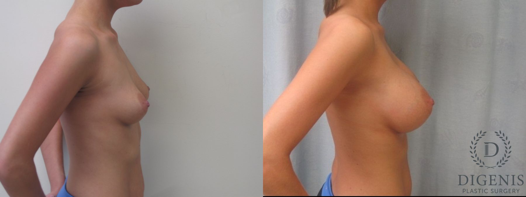 Before and after Breast Augmentation case 35087 - Angle 5