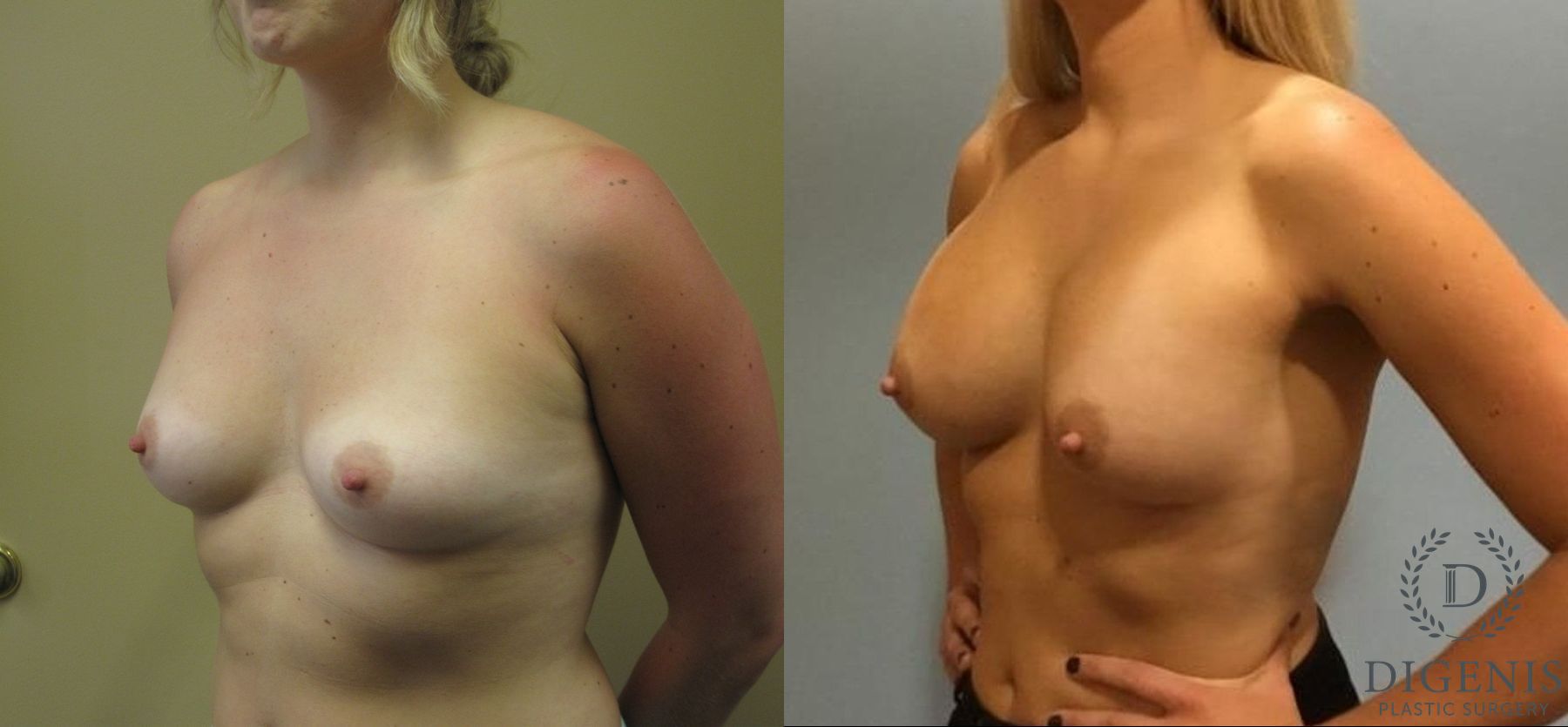 Before and after Breast Augmentation case 35091 - Angle 4