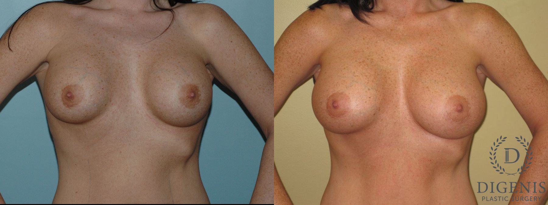 Before and after Breast Implant Exchange or Removal case 35125