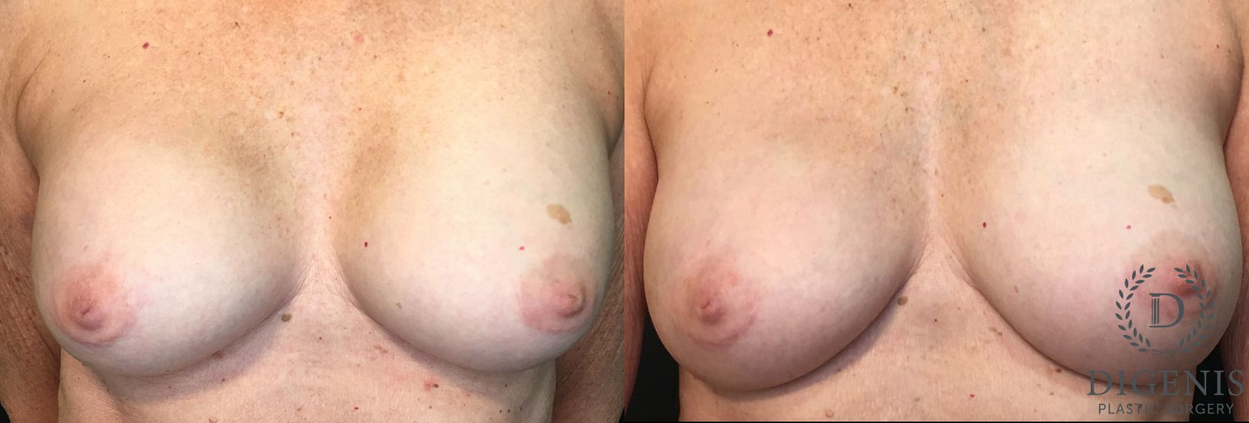 Before and after Breast Implant Exchange case 35159